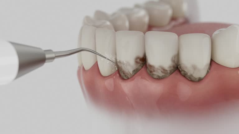 Trusted Wisdom Tooth Removal service in Williamsburg, FL - Dentist Open Now